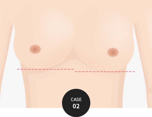 CASE 02