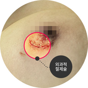 외과적 절제술