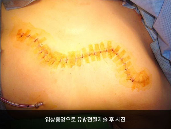 엽상종양으로 유방전절제술 후 사진