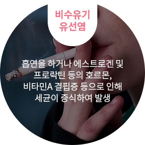 비수유기 유선염 : 흡연을 하거나 에스트로겐 및 프로락틴 등의 호르몬, 비타민A 결핍증 등으로 인해 세균이 증식하여 발생