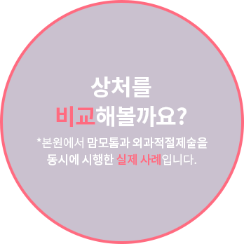 상처를 비교해볼까요? *본원에서 맘모톰과 외과적절제술을 동시에 시행한 실제 사례입니다.