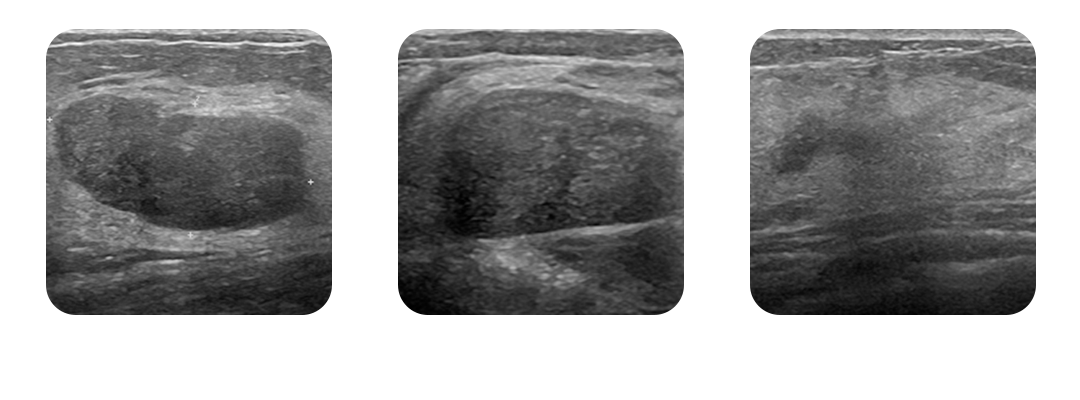 시술 사진